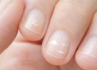 Cum iti dai seama ca duci lipsa de calciu Lipsa de calciu